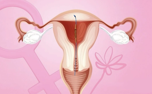 Boncuklu Spiral (GyneFix) Taktırma Ankara