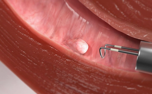 Hysteroscopic Polyp Surgery Turkey